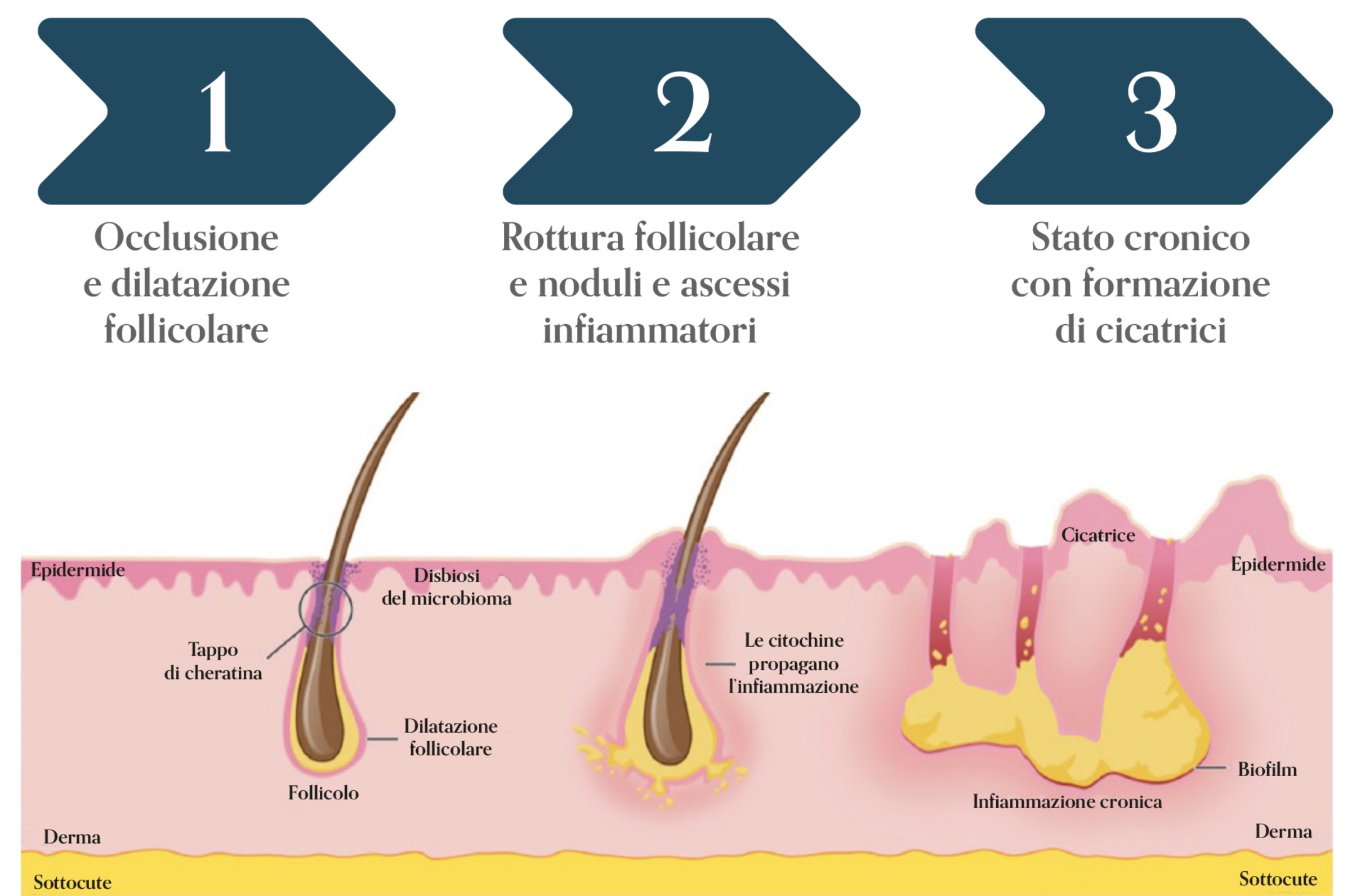 Possibile sequenza di eventi alla base dell’HS